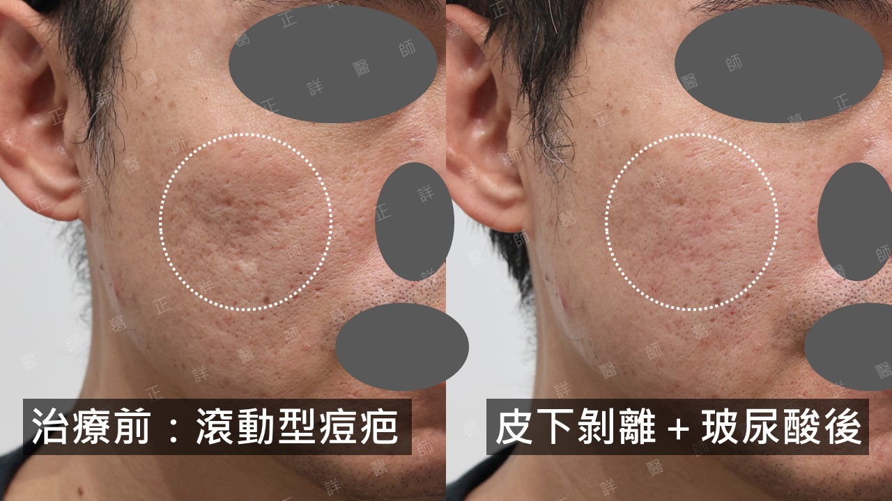 痘疤治療指引—手術篇:皮下剝離、真皮移植、穿刺移植、穿刺提升、切縫 - 悅之美皮膚專科診所