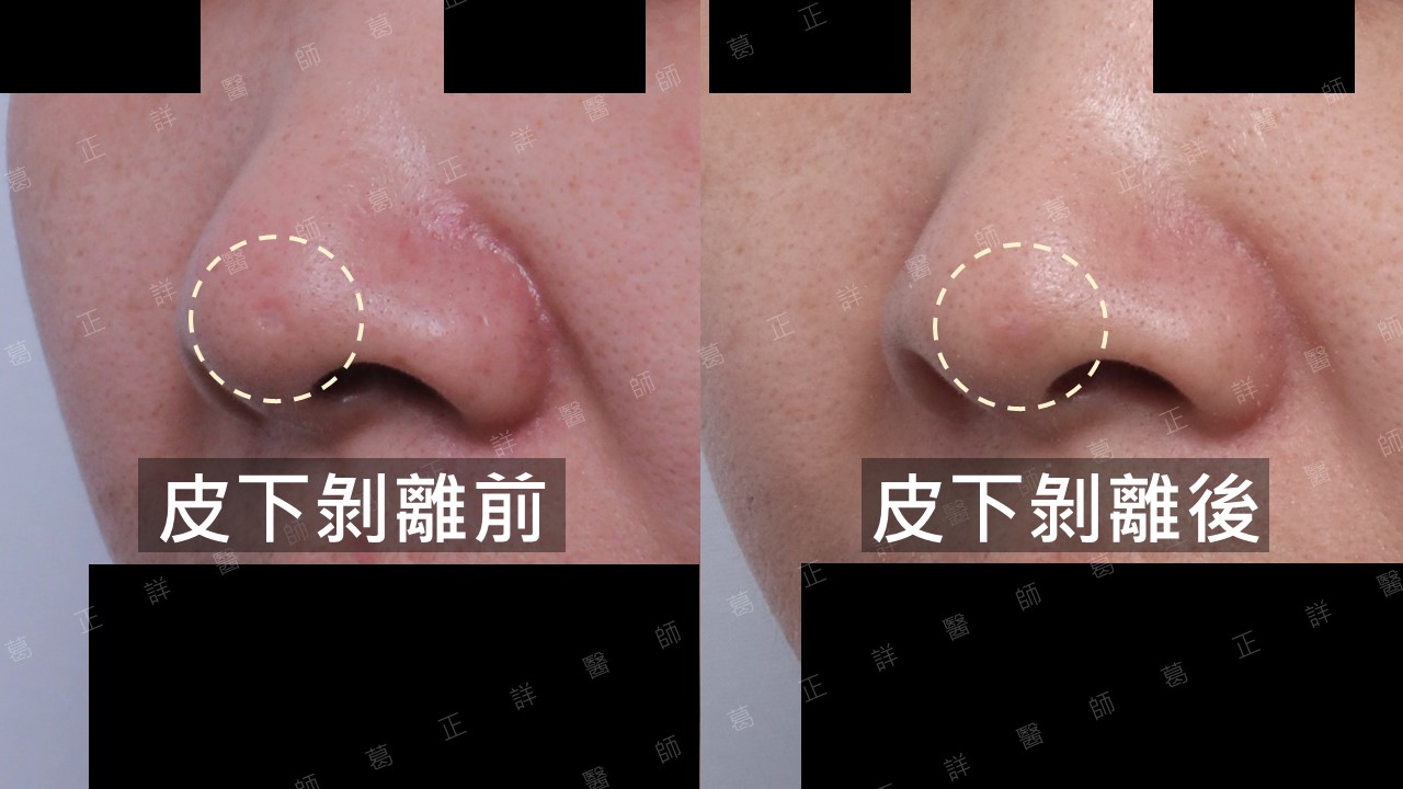 痘疤治療指引—手術篇:皮下剝離、真皮移植、穿刺移植、穿刺提升、切縫 - 悅之美皮膚專科診所