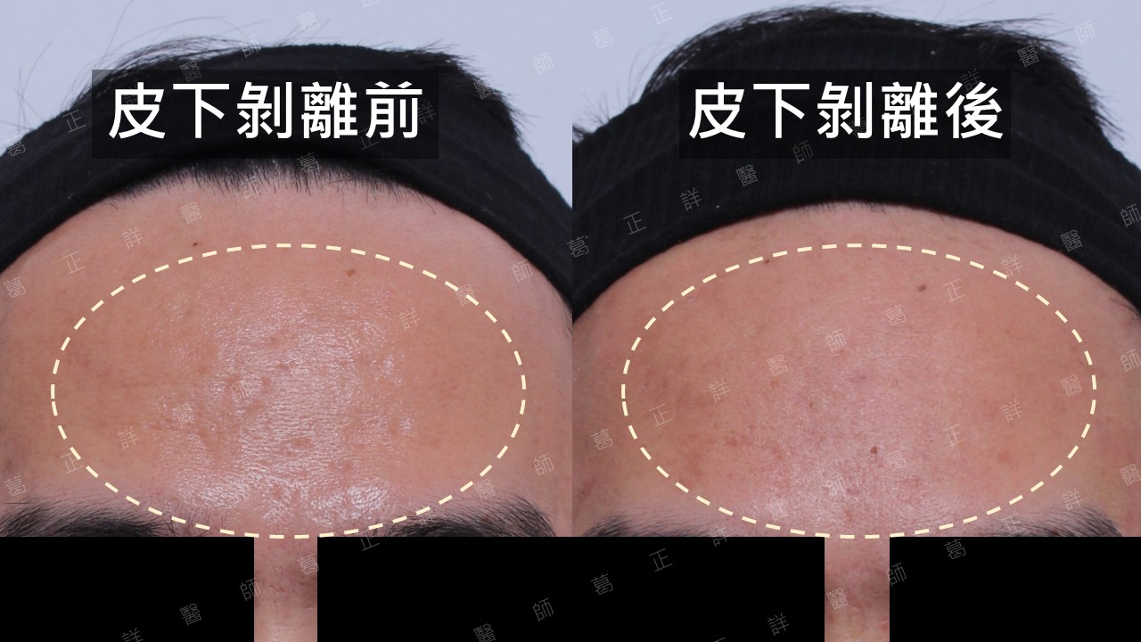 痘疤治療指引—手術篇:皮下剝離、真皮移植、穿刺移植、穿刺提升、切縫 - 悅之美皮膚專科診所