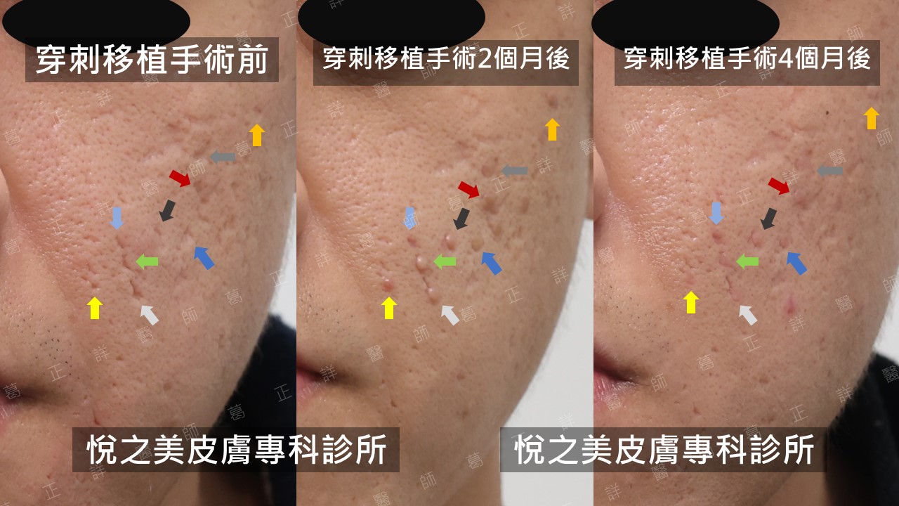 痘疤治療指引—手術篇:皮下剝離、真皮移植、穿刺移植、穿刺提升、切縫 - 悅之美皮膚專科診所
