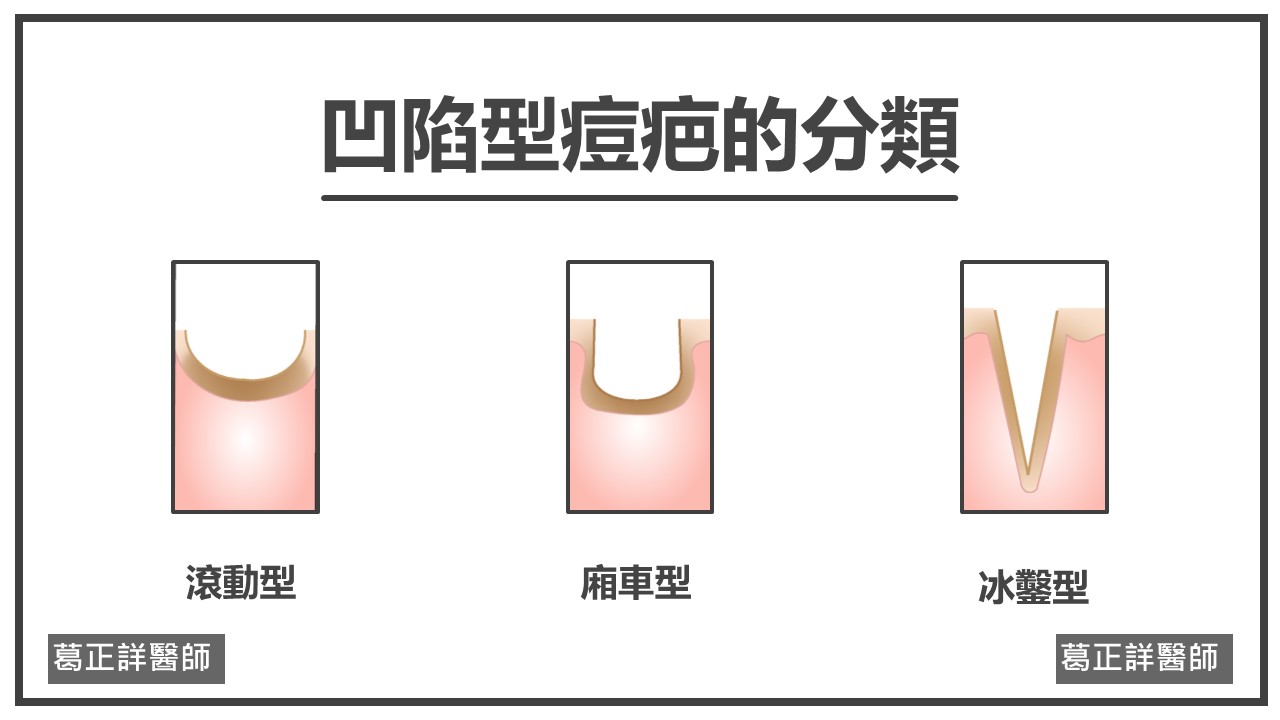 凹痘疤分類示意圖