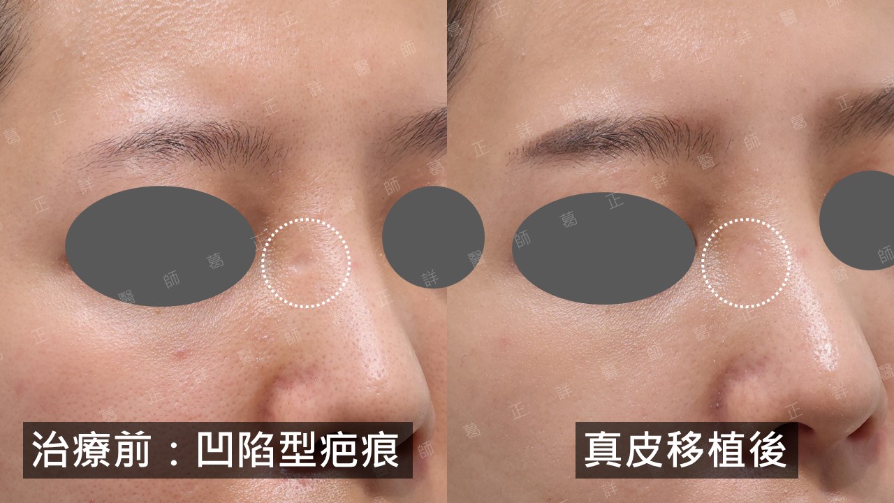 右側鼻樑深凹洞疤痕以真皮移植成功治療