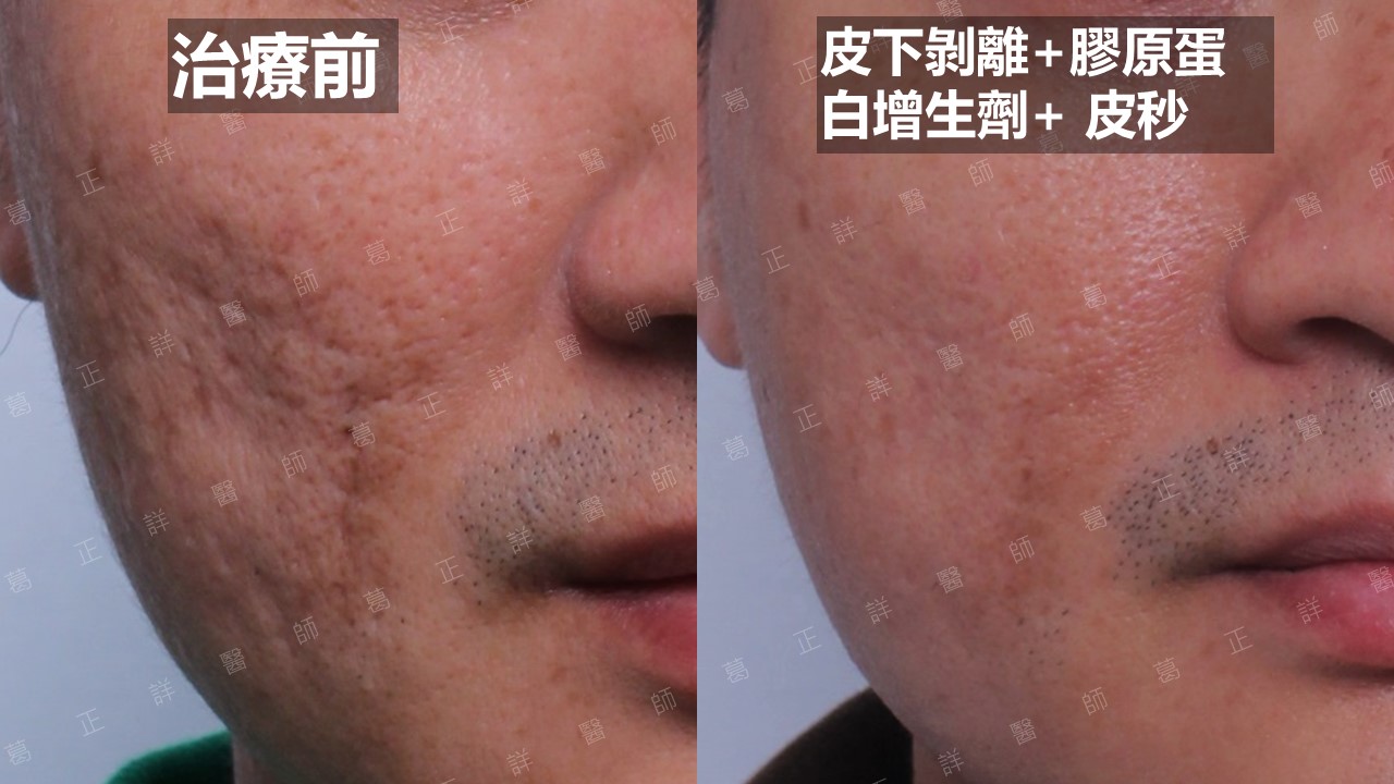 皮下剝離+皮秒雷射+舒顏萃改善嚴重臉頰痘疤
