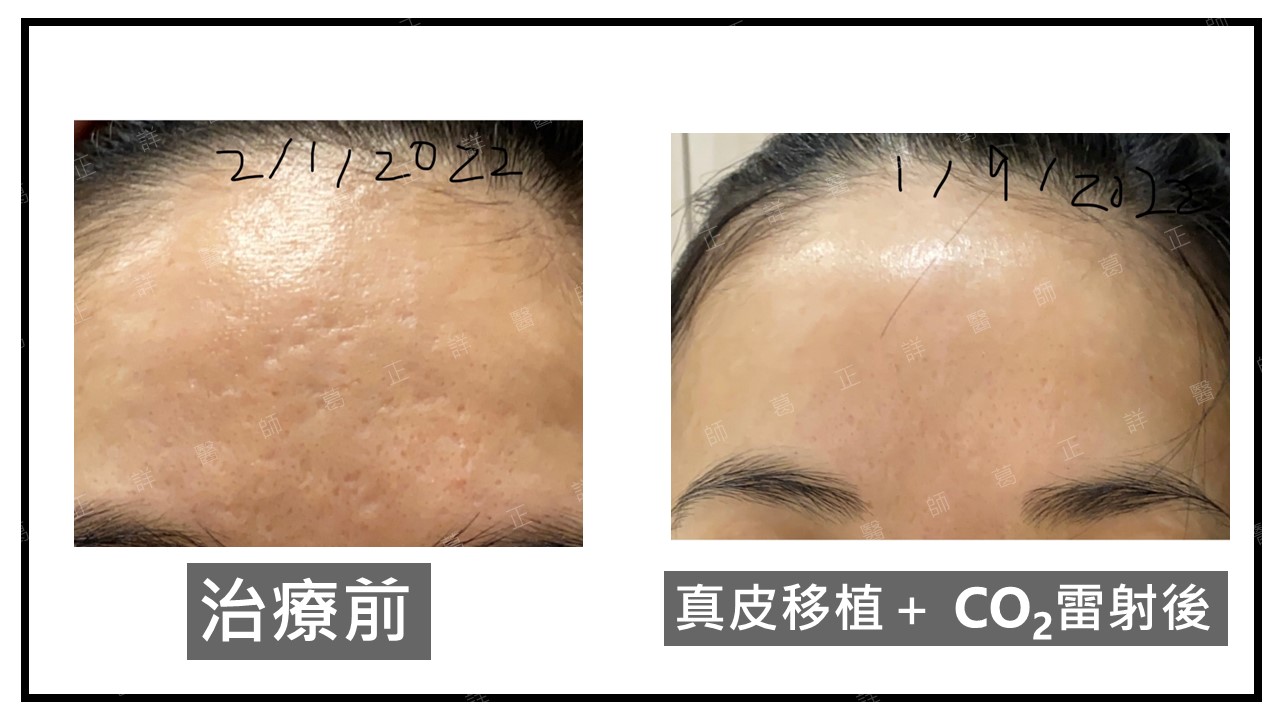 香港患者，CO2雷射+真皮移植治好痘疤