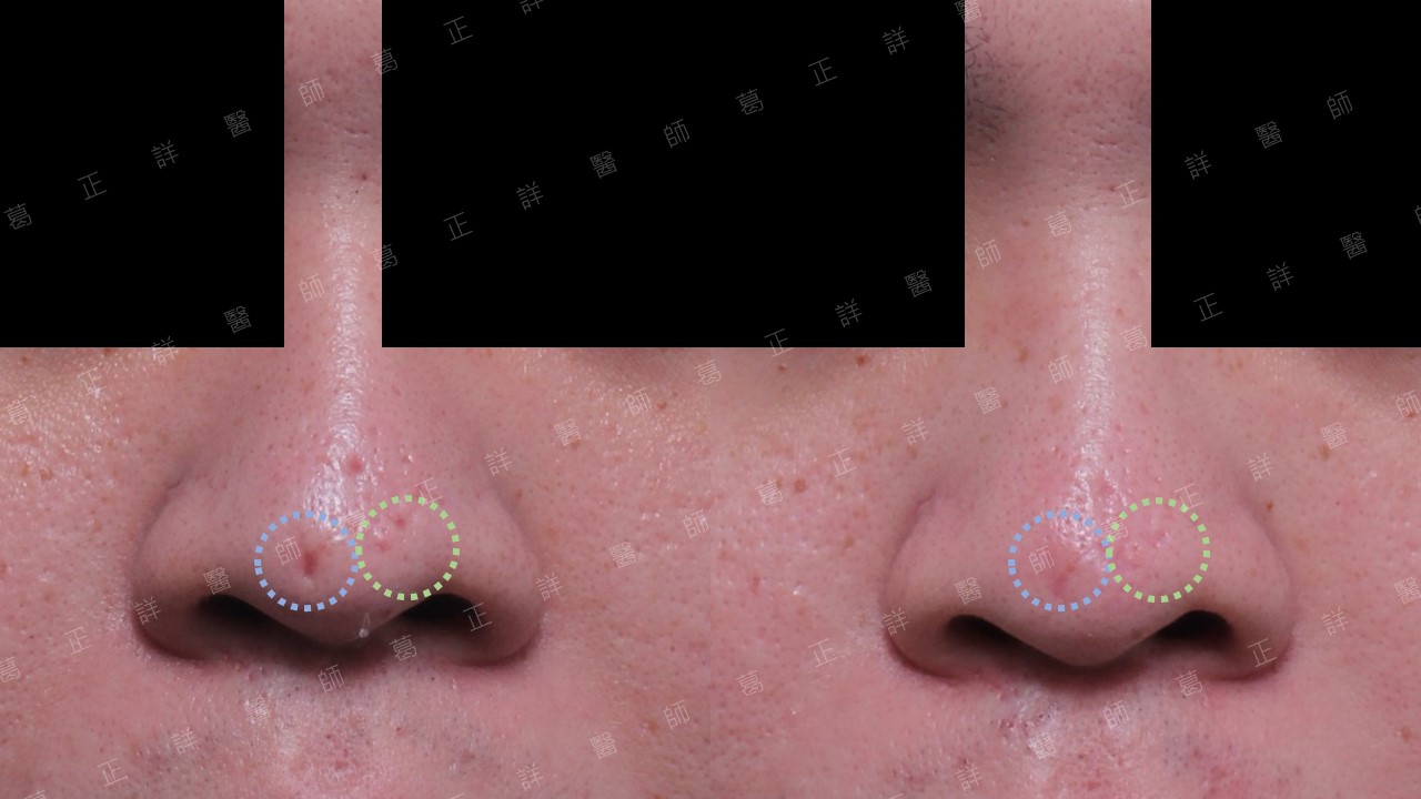 鼻痘疤真皮移植與TCA-嚴重鼻痘疤