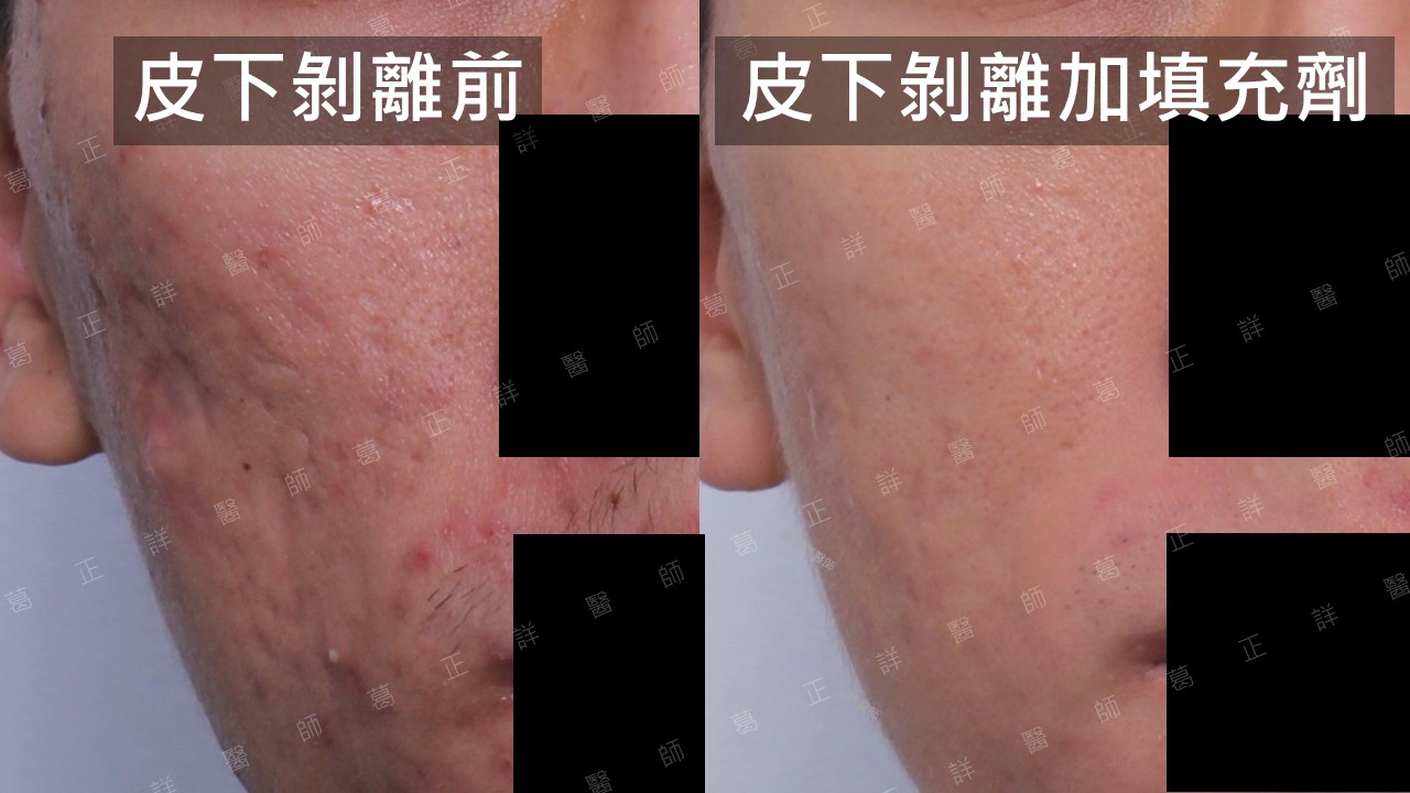 皮下剝離+填充劑改善臉頰痘疤