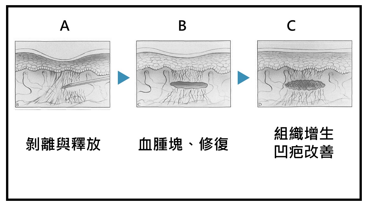 皮下剝離原理