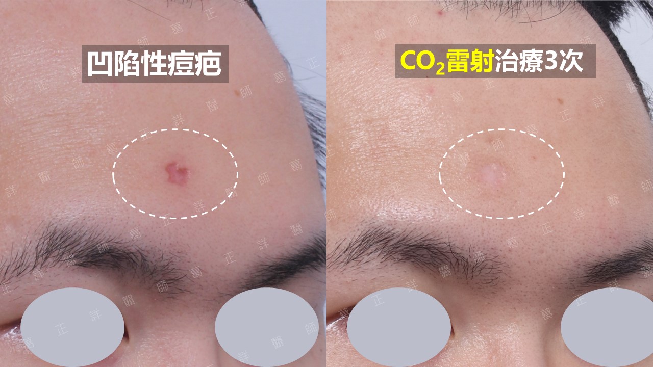 CO2雷射治療額頭痘疤