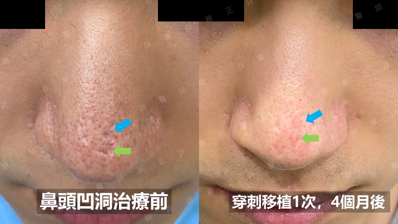 鼻子凹疤-穿刺移植-長期效果