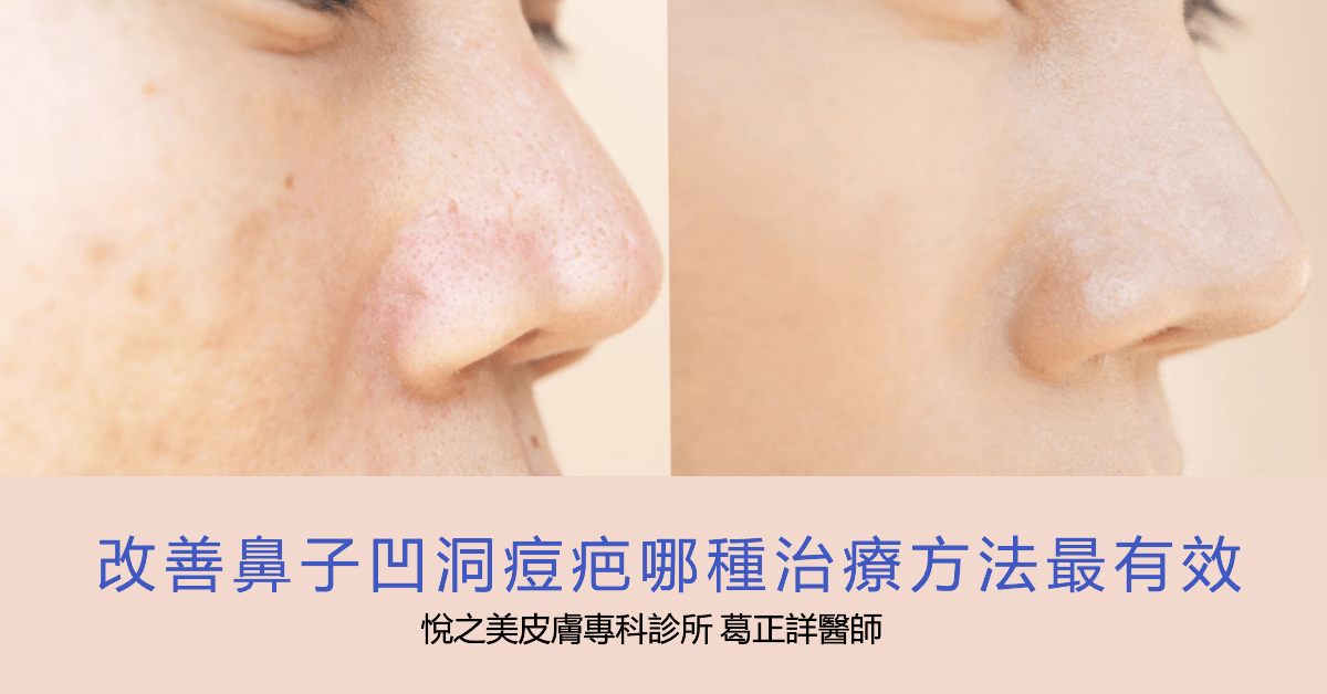 改善鼻子凹洞痘疤哪種治療方法最有效？
